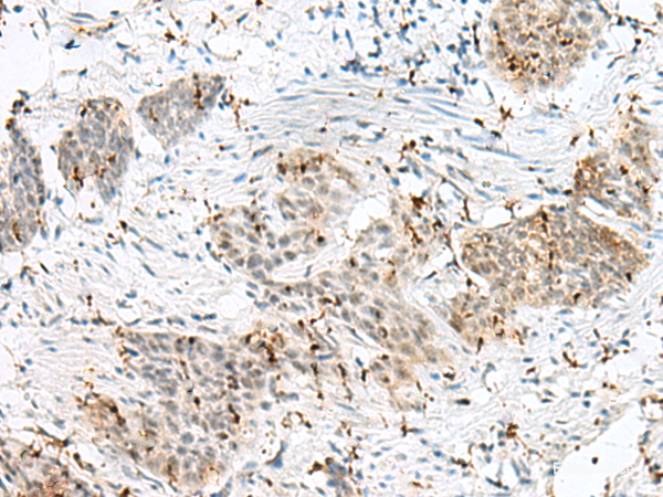 Immunohistochemistry of paraffin-embedded Human esophagus cancer tissue  using PLCL2 Polyclonal Antibody at dilution of 1:50(×200)