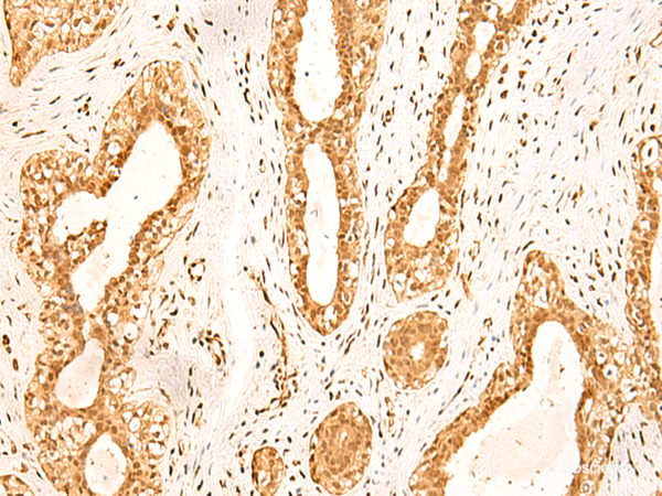 Immunohistochemistry of paraffin-embedded Human breast cancer tissue  using ZNF471 Polyclonal Antibody at dilution of 1:50(×200)