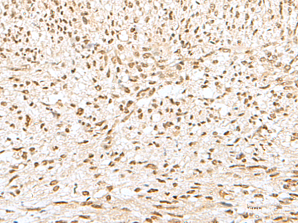 Immunohistochemistry of paraffin-embedded Human liver cancer tissue  using GTF2A2 Polyclonal Antibody at dilution of 1:30(×200)