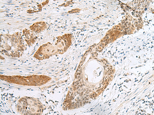 Immunohistochemistry of paraffin-embedded Human esophagus cancer tissue  using HIST1H2BK Polyclonal Antibody at dilution of 1:40(×200)