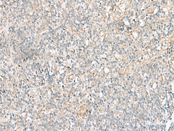 Immunohistochemistry of paraffin-embedded Human tonsil tissue  using GSKIP Polyclonal Antibody at dilution of 1:55(×200)