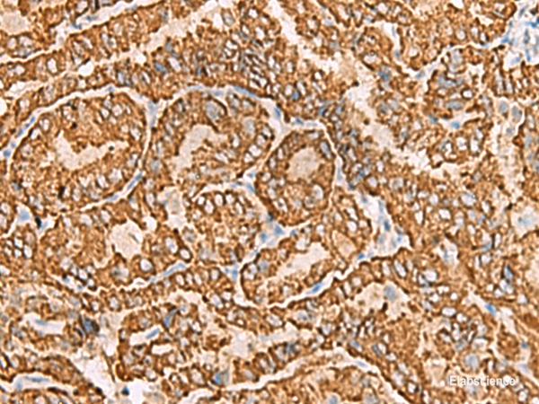 Immunohistochemistry of paraffin-embedded Human thyroid cancer tissue  using NPC2 Polyclonal Antibody at dilution of 1:80(×200)