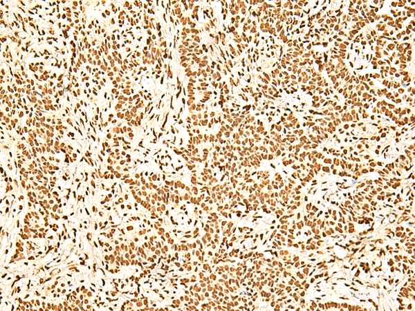 Immunohistochemistry of paraffin-embedded Human ovarian cancer tissue  using ILF3 Polyclonal Antibody at dilution of 1:60(×200)