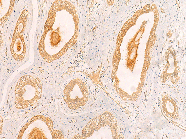Immunohistochemistry of paraffin-embedded Human breast cancer tissue  using ZNF580 Polyclonal Antibody at dilution of 1:40(×200)