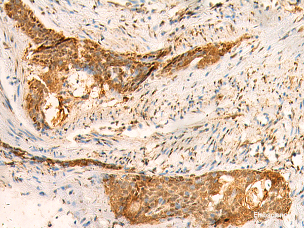 Immunohistochemistry of paraffin-embedded Human esophagus cancer tissue  using SMUG1 Polyclonal Antibody at dilution of 1:50(×200)
