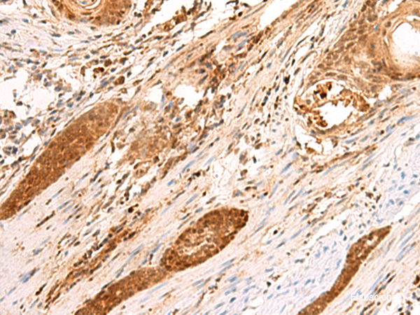 Immunohistochemistry of paraffin-embedded Human esophagus cancer tissue  using SCAND1 Polyclonal Antibody at dilution of 1:90(×200)