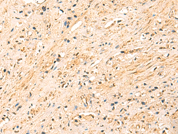 Immunohistochemistry of paraffin-embedded Human prost at e cancer tissue  using EEF1AKMT2 Polyclonal Antibody at dilution of 1:50(×200)