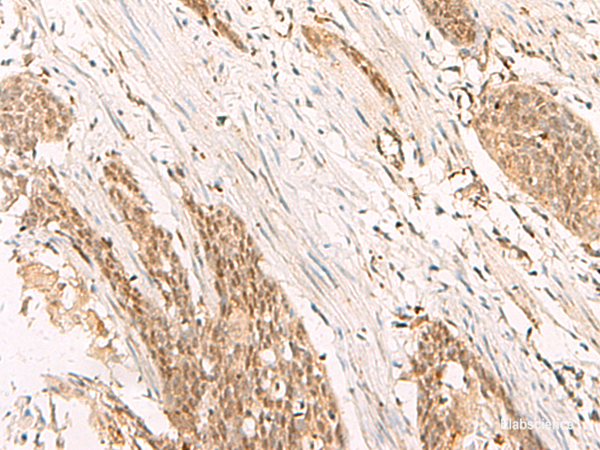 Immunohistochemistry of paraffin-embedded Human esophagus cancer tissue  using POP4 Polyclonal Antibody at dilution of 1:65(×200)