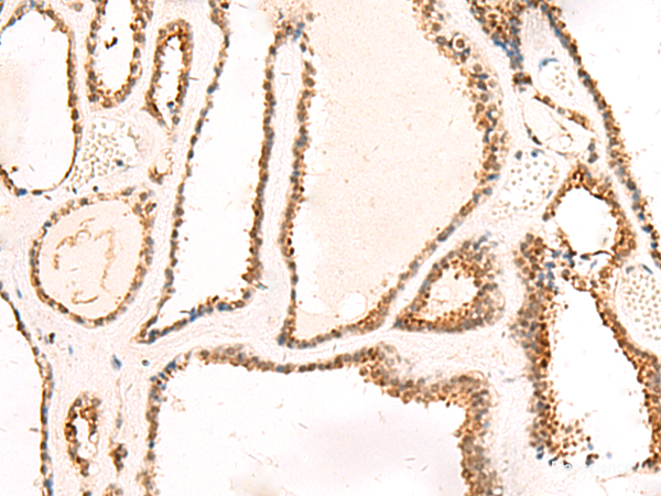 Immunohistochemistry of paraffin-embedded Human thyroid cancer tissue  using DCAF10 Polyclonal Antibody at dilution of 1:130(×200)