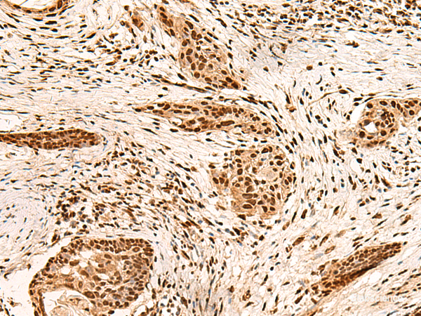 Immunohistochemistry of paraffin-embedded Human esophagus cancer tissue  using PAFAH1B2 Polyclonal Antibody at dilution of 1:60(×200)