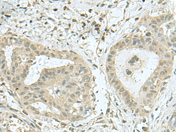 Immunohistochemistry of paraffin-embedded Human thyroid cancer tissue  using THTPA Polyclonal Antibody at dilution of 1:70(×200)