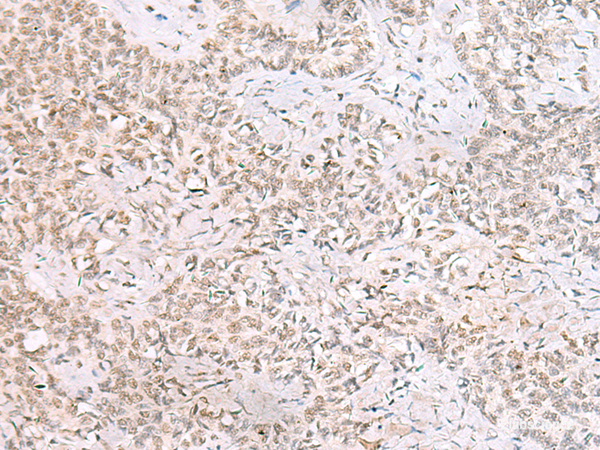 Immunohistochemistry of paraffin-embedded Human ovarian cancer tissue  using SMNDC1 Polyclonal Antibody at dilution of 1:50(×200)