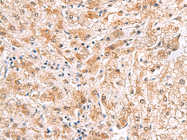 Immunohistochemistry of paraffin-embedded Human liver cancer tissue  using PDCL2 Polyclonal Antibody at dilution of 1:65(×200)