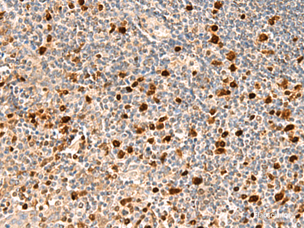 Immunohistochemistry of paraffin-embedded Human tonsil tissue  using DUT Polyclonal Antibody at dilution of 1:70(×200)