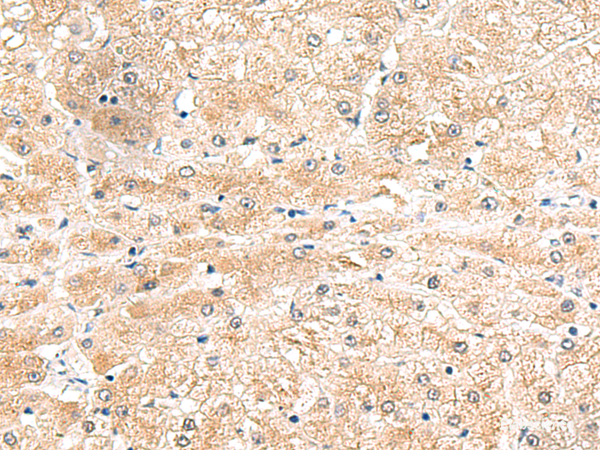 Immunohistochemistry of paraffin-embedded Human liver cancer tissue  using LRG1 Polyclonal Antibody at dilution of 1:50(×200)