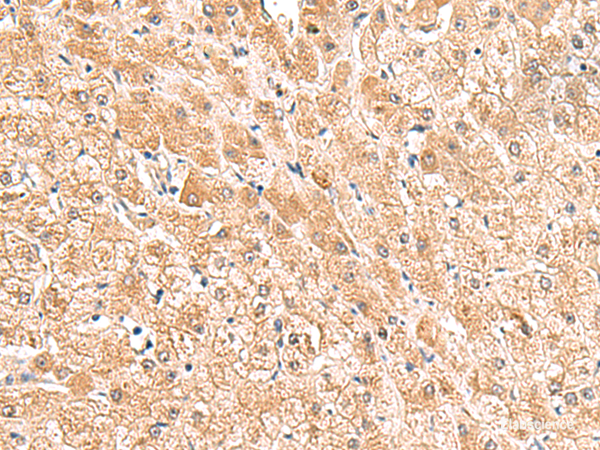 Immunohistochemistry of paraffin-embedded Human liver cancer tissue  using TRUB1 Polyclonal Antibody at dilution of 1:85(×200)