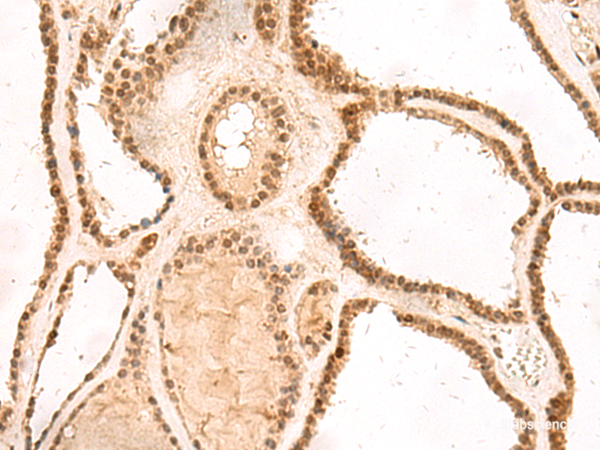 Immunohistochemistry of paraffin-embedded Human thyroid cancer tissue  using MKX Polyclonal Antibody at dilution of 1:60(×200)