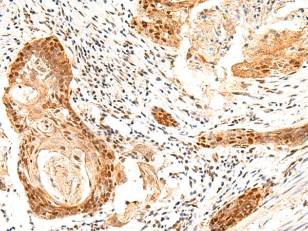 Immunohistochemistry of paraffin-embedded Human esophagus cancer tissue  using SETMAR Polyclonal Antibody at dilution of 1:60(×200)