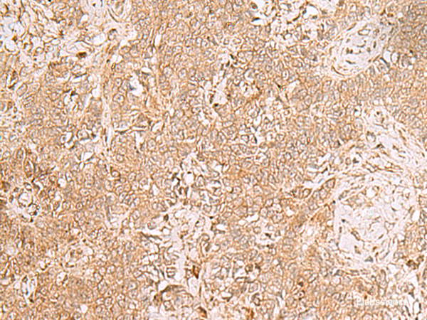 Immunohistochemistry of paraffin-embedded Human ovarian cancer tissue  using GMPPB Polyclonal Antibody at dilution of 1:50(×200)