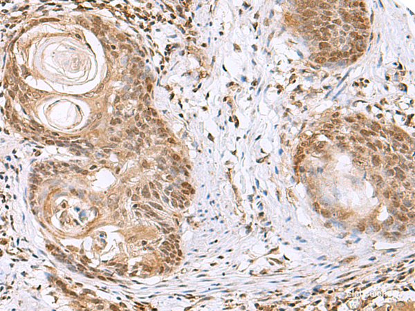 Immunohistochemistry of paraffin-embedded Human esophagus cancer tissue  using ELAC1 Polyclonal Antibody at dilution of 1:65(×200)