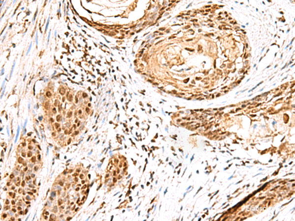 Immunohistochemistry of paraffin-embedded Human esophagus cancer tissue  using ELF3 Polyclonal Antibody at dilution of 1:95(×200)