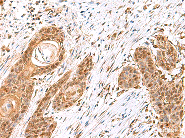 Immunohistochemistry of paraffin-embedded Human esophagus cancer tissue  using MECR Polyclonal Antibody at dilution of 1:60(×200)