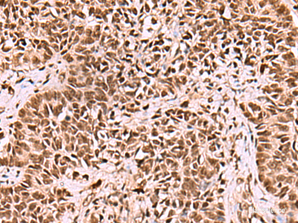 Immunohistochemistry of paraffin-embedded Human ovarian cancer tissue  using LDB1 Polyclonal Antibody at dilution of 1:70(×200)