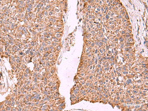 Immunohistochemistry of paraffin-embedded Human esophagus cancer tissue  using PER3 Polyclonal Antibody at dilution of 1:55(×200)