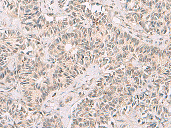Immunohistochemistry of paraffin-embedded Human ovarian cancer tissue  using RNF13 Polyclonal Antibody at dilution of 1:60(×200)