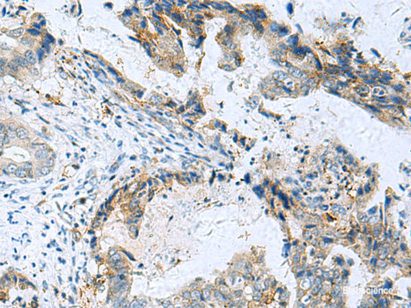Immunohistochemistry of paraffin-embedded Human cervical cancer tissue  using RMDN2 Polyclonal Antibody at dilution of 1:70(×200)