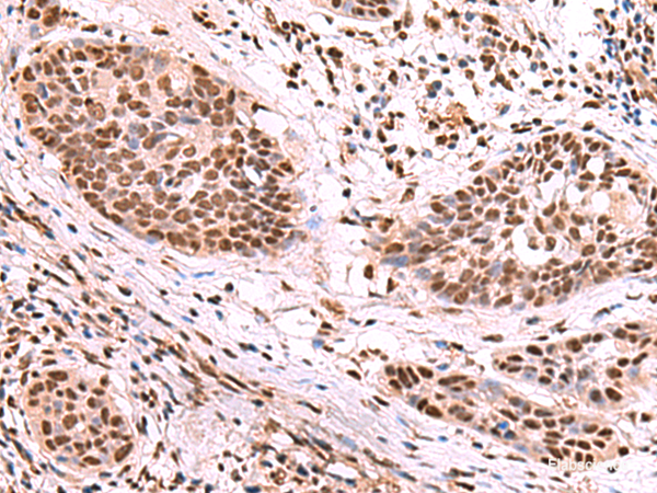 Immunohistochemistry of paraffin-embedded Human esophagus cancer tissue  using SF3B3 Polyclonal Antibody at dilution of 1:70(×200)