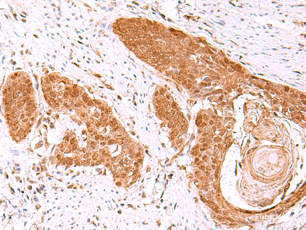 Immunohistochemistry of paraffin-embedded Human esophagus cancer tissue  using FDPS Polyclonal Antibody at dilution of 1:60(×200)
