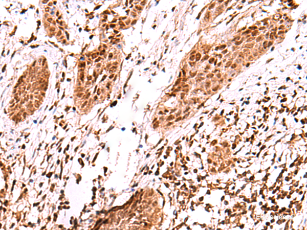 Immunohistochemistry of paraffin-embedded Human esophagus cancer tissue  using AK9 Polyclonal Antibody at dilution of 1:60(×200)