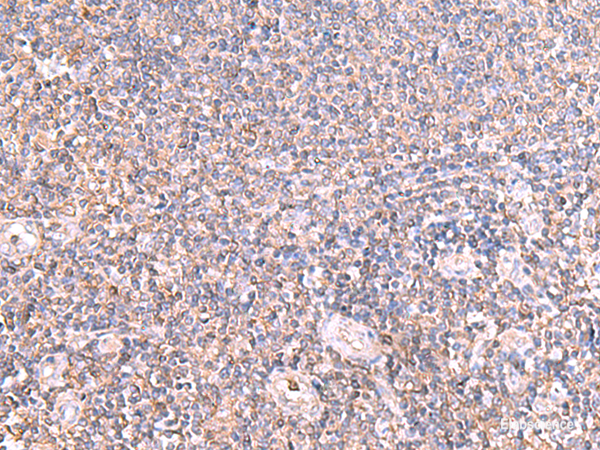 Immunohistochemistry of paraffin-embedded Human tonsil tissue  using IFT57 Polyclonal Antibody at dilution of 1:85(×200)
