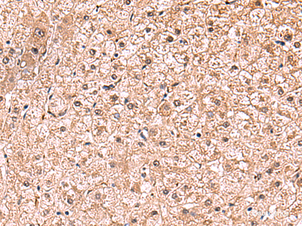 Immunohistochemistry of paraffin-embedded Human liver cancer tissue  using RUSC1 Polyclonal Antibody at dilution of 1:90(×200)