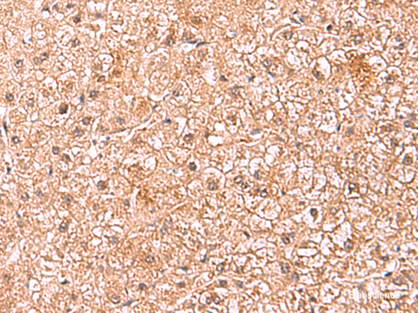 Immunohistochemistry of paraffin-embedded Human liver cancer tissue  using ASTN2 Polyclonal Antibody at dilution of 1:80(×200)