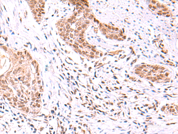 Immunohistochemistry of paraffin-embedded Human esophagus cancer tissue  using TRMT12 Polyclonal Antibody at dilution of 1:80(×200)