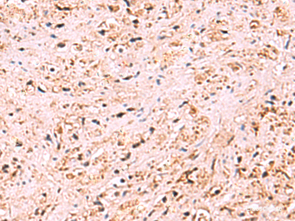 Immunohistochemistry of paraffin-embedded Human prost at e cancer tissue  using ZSWIM1 Polyclonal Antibody at dilution of 1:95(×200)