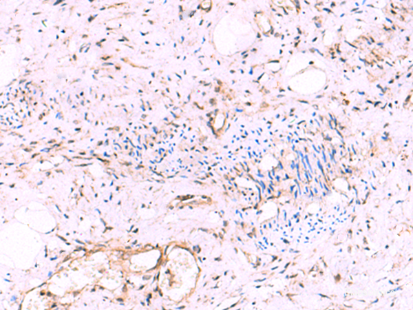 Immunohistochemistry of paraffin-embedded Human cervical cancer tissue  using KATNAL1 Polyclonal Antibody at dilution of 1:95(×200)