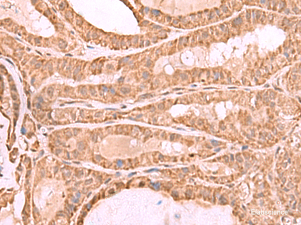 Immunohistochemistry of paraffin-embedded Human thyroid cancer tissue  using CDC20 Polyclonal Antibody at dilution of 1:70(×200)