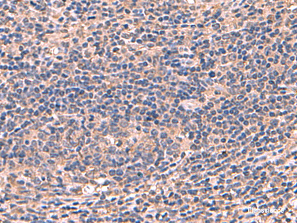 Immunohistochemistry of paraffin-embedded Human cervical cancer tissue  using AHCYL1 Polyclonal Antibody at dilution of 1:70(×200)