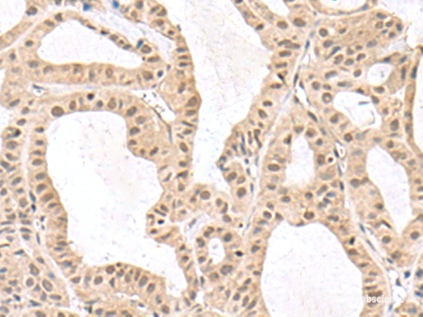 Immunohistochemistry of paraffin-embedded Human thyroid cancer tissue  using RPS6KA5 Polyclonal Antibody at dilution of 1:170(×200)