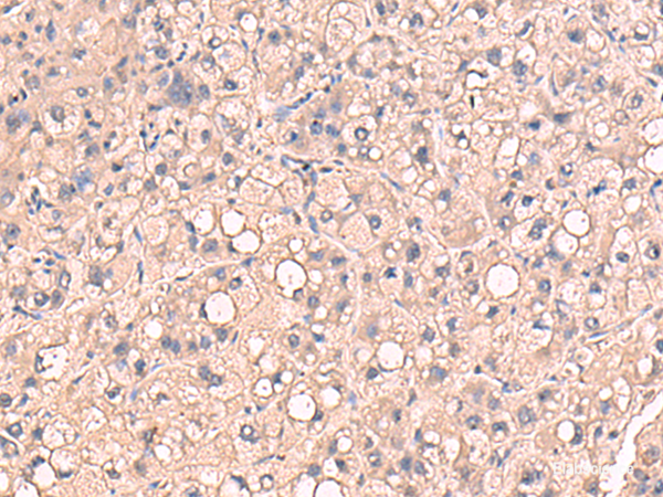 Immunohistochemistry of paraffin-embedded Human liver cancer tissue  using RIOK1 Polyclonal Antibody at dilution of 1:80(×200)