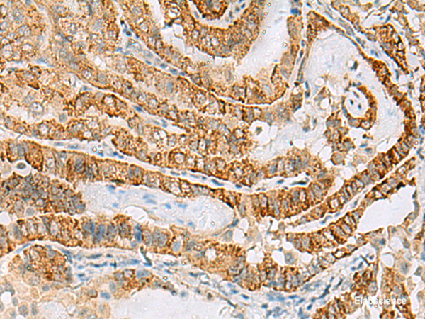 Immunohistochemistry of paraffin-embedded Human thyroid cancer tissue  using FARP2 Polyclonal Antibody at dilution of 1:70(×200)