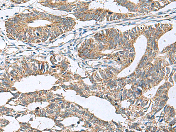 Immunohistochemistry of paraffin-embedded Human colorectal cancer tissue  using DPY19L3 Polyclonal Antibody at dilution of 1:120(×200)