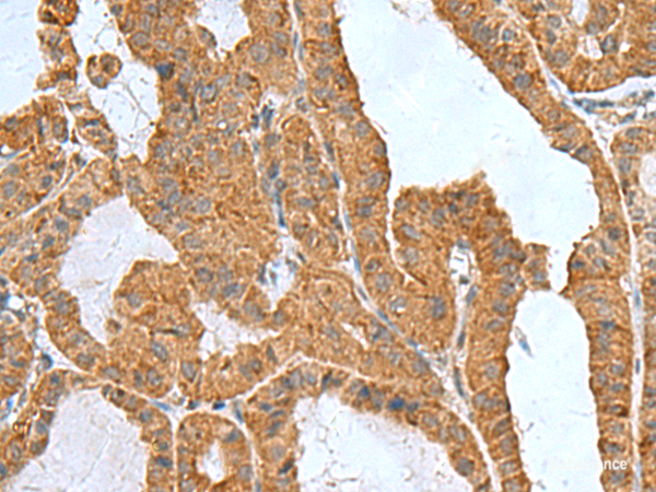 Immunohistochemistry of paraffin-embedded Human thyroid cancer tissue  using ITGB1BP1 Polyclonal Antibody at dilution of 1:50(×200)