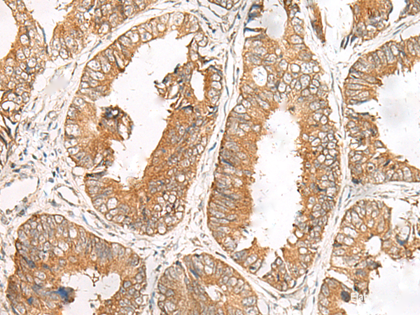 Immunohistochemistry of paraffin-embedded Human colorectal cancer tissue  using FERD3L Polyclonal Antibody at dilution of 1:85(×200)