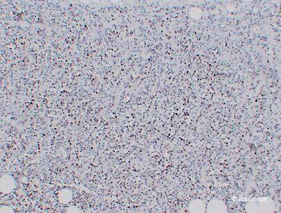 Immunohistochemistry of paraffin-embedded Human Plasmacytoma using KI67 Monoclonal Antibody at dilution of 1:200.
