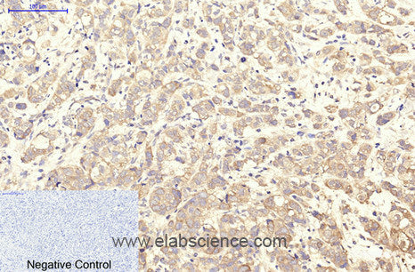 Immunohistochemistry of paraffin-embedded Human breast cancer tissue using ITGA2B Monoclonal Antibody at dilution of 1:200.