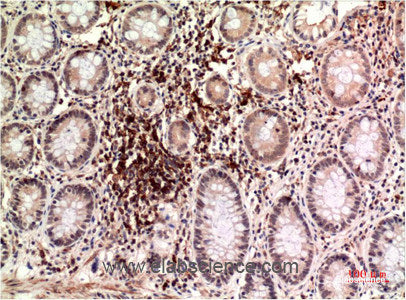 Immunohistochemistry of paraffin-embedded Human colon carcinoma tissue using Epsilon Tubulin Monoclonal Antibody at dilution of 1:200.